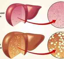 Bezalkoholno bolest masne jetre: liječenje