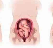 Pogrešno položaj i predstavljanje fetusa tijekom trudnoće