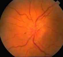 Optički neuritis: simptoma, liječenje, uzroci, dijagnoza, prognoza