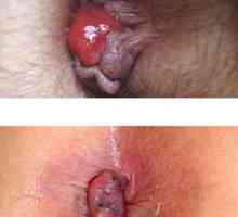 Naoštreni (akutni) vanjske i unutarnje hemoroide