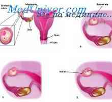 Ispitivanje maternice. Ispitivanje zdjelične šupljine s izvanmaterične trudnoće