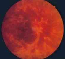 Okluzija retinalne vene: liječenje