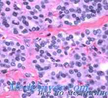Onkotsitarnaya adenom ili adenoma Hürthleove stanice. Postbronhialny rak Getsov