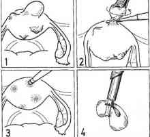 Kirurgija na maternicu. Laparoskopska myomectomy