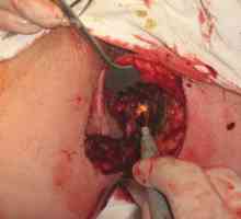 Kirurgija za uklanjanje hemoroide i analni pukotina