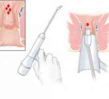 Kirurgija za uklanjanje hemoroide laserski trenutni liječenje hemoroida