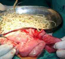 Kirurgija za uklanjanje crva, kako ukloniti helminti?
