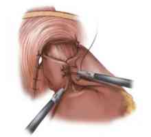 Kirurško liječenje refluksoezofagitisa i fundoplication