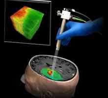 Optička sonda za uklanjanje tumora mozga