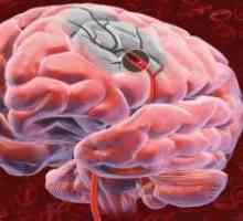 Tumor mozga i njegove membrane, što dovodi do sloma vidnog puta