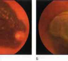 Tumori mrežnice i choroid: žilnice melanom