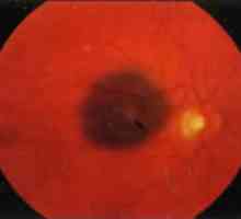 Tumori mrežnice i choroid: koroidalne nevus