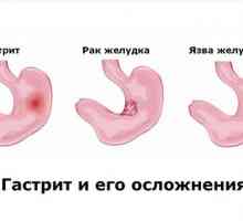 Komplikacije gastritisa