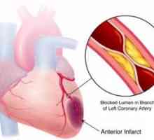 Akutni koronarni zatajenje srca