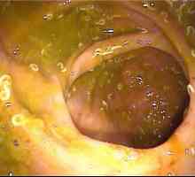 Pinworms u crijevo, anus, anus crijevne enterobiosis