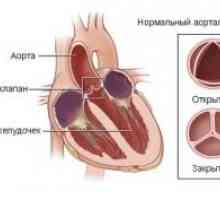 Akutni disfunkcija srčanih zalistaka