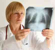 Akutni bronhitis, liječenje, simptomi, znakovi, uzroci, prevencija, dijagnoza
