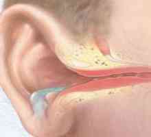 Akutnim gnojnim upala srednjeg uha: liječenje, simptomi, znakovi, uzroci