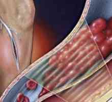 Akutna tromboza dubokih vena donjih ekstremiteta: liječenje, simptomi