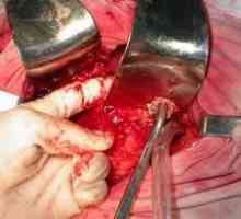 Pancreatonecrosis operacija razdoblje nakon operacije