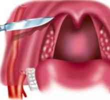 Peritonzilarnog apsces i paratonzillit: liječenje, simptomi, uzroci, simptomi