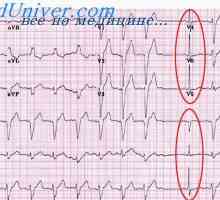 Angine i infarkta na EKG. Promjene u T-vala na elektrokardiogram