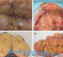 Primarni aldosteronizam (CT bolest) morfologiju, patološko anatomija