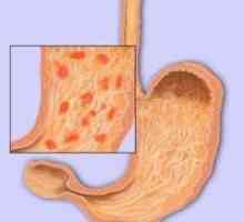 Prvi znakovi i simptomi gastritisa želucu