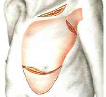 Plastični uklanjanje mekih tkiva u prsima zidne mane. Ectopectoralis