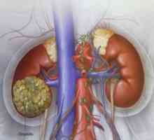 Karcinom bubrežnih stanica: liječenja, simptomi, uzroci, simptomi