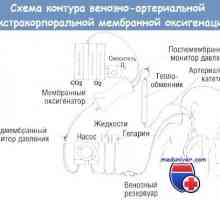 Ekstrakorporalni komplikacije membrane oksigenacija (ECMO)