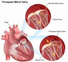 Mitralne srca ventil: liječenje, simptomi