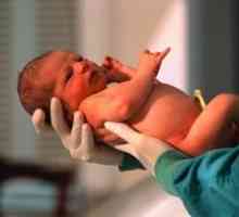 Malformacija kod novorođenčadi