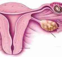 Gubitak trudnoće: cervikalna insuficijencija
