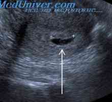 Prestanak trudnoće s malformacijama. Značenje antenatalni dijagnoze malformacije