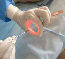 Laser kauterizacija želuca kao metoda liječenja