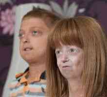 Progerija djece: simptomi, liječenje, uzroci
