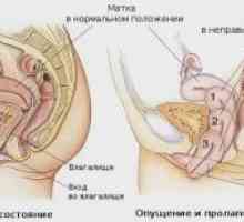 Prolaps maternice i vagine: liječenje, simptomi, kirurgija