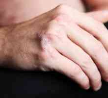 Psorijatični artropatija, liječenje, simptomi, znakovi, uzroci