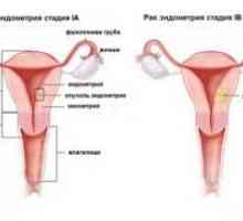 Endometrija rak: simptomi, fazi, liječenje, dijagnozi, prognozi, uzrokuje, simptoma, sprečavanje