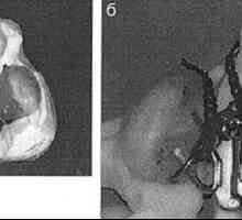 Rano ortopedska liječenje bolesnika s obostranom rascjepom usne i nepca uz korištenje fiksnih…