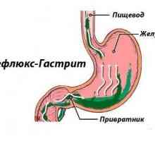 Refluks gastritis: Znakovi, simptomi i tretman