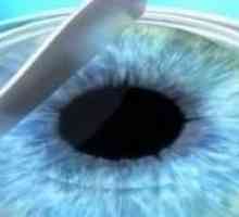 Kirurgija loma očiju: Što je to?
