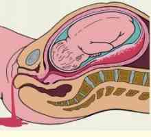 Rektalno krvarenje u trudnoći