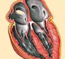 Restriktivna kardiomiopatija