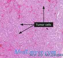 Clasmocytoma i limfomi štitne žlijezde. Fluorescentna mikroskopija štitnjače