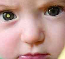 Retinoblastom u djece: simptomi, liječenje, uzroci, simptomi