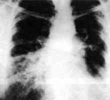 Rezultati thoracoscopic biopsije pluća