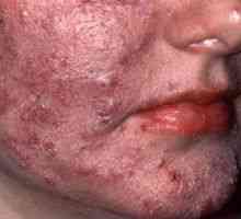 Koža rosacea: liječenje, simptomi, uzroci, simptomi