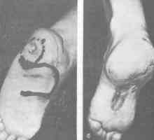 Ožiljak deformitet stopala i gležnja. nedostaci tretman Plantarna površina stopala u odnosu na…
